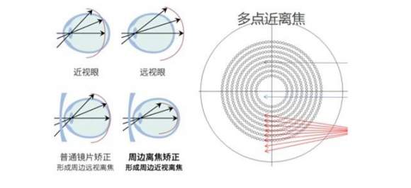 防控镜片：助力青少年近视防控